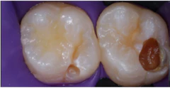 Materiales dentales