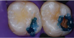 Materiales dentales